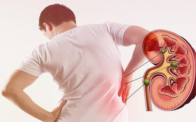 nước suối có tốt cho người bị sỏi thận