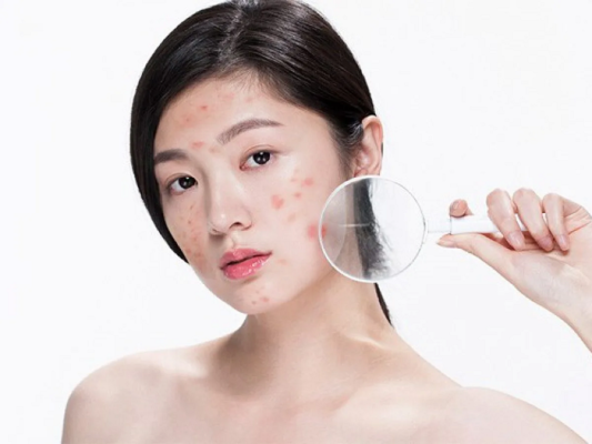 Những lợi ích của uống nước giúp ngừa mụn cho da