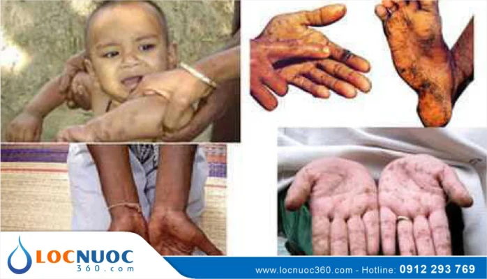 Tác hại nghiêm trọng của nước sinh hoạt nhiễm Sắt phèn